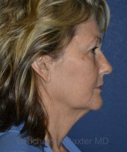 before facelift | neck lift female patient right side view case 4836
