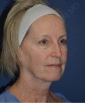 before facelift | neck lift female patient right angle view case 4839