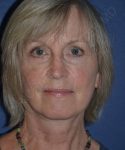 after facelift | neck lift female patient front view case 4839