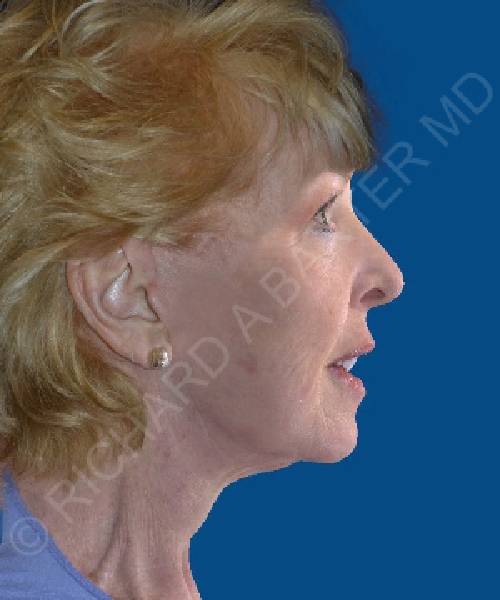 after facelift | neck lift female patient right side view case 4844