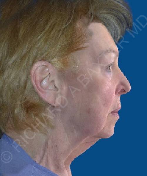 before facelift | neck lift female patient right side view case 4844