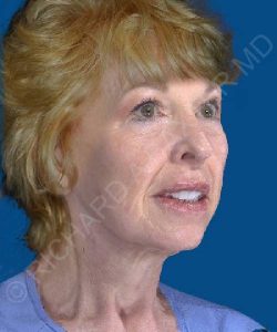 after facelift | neck lift female patient right angle view case 4844