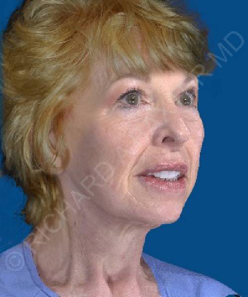 after facelift | neck lift female patient right angle view case 4844