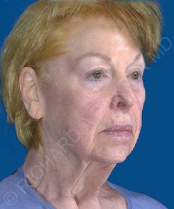 before facelift | neck lift female patient right angle view case 4844