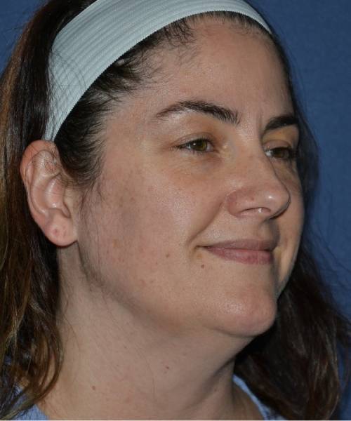 before facelift | neck lift female patient right angle view case 4849