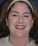 after facelift | neck lift female patient front view case 4849