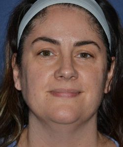 before facelift | neck lift female patient front view case 4849