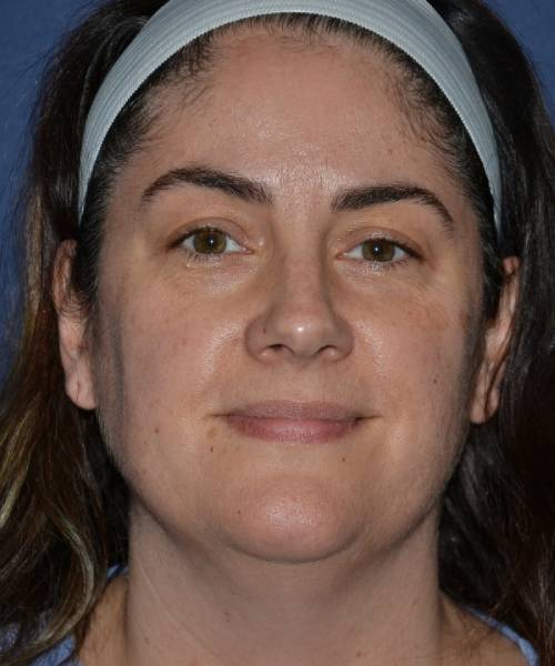 before facelift | neck lift female patient front view case 4849