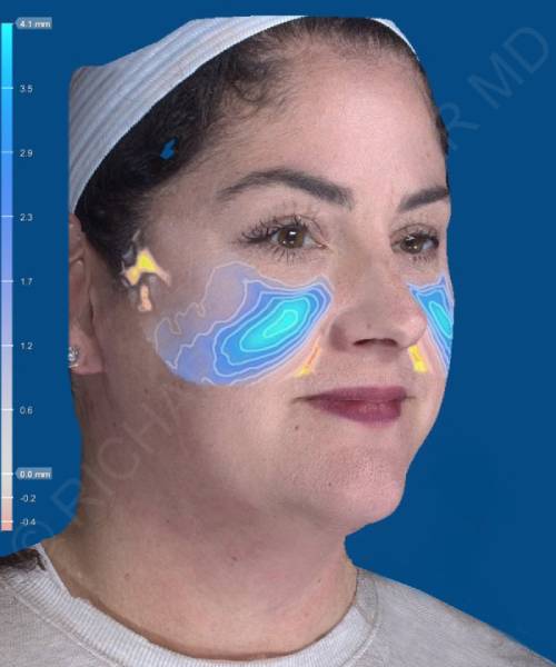 before facelift | neck lift female patient right angle view case 4849