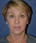 after facelift | neck lift female patient front view case 4856