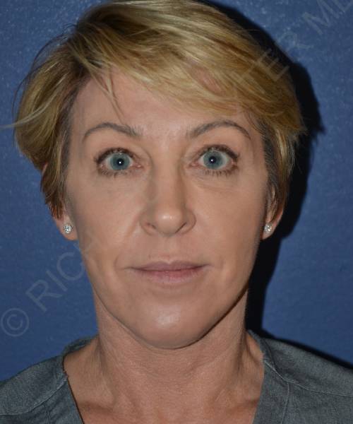 after facelift | neck lift female patient front view case 4856