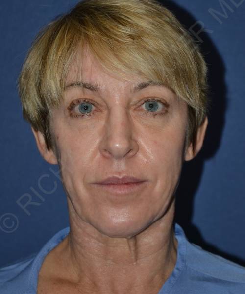 before facelift | neck lift female patient front view case 4856