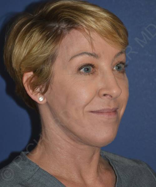 after facelift | neck lift female patient right angle view case 4856