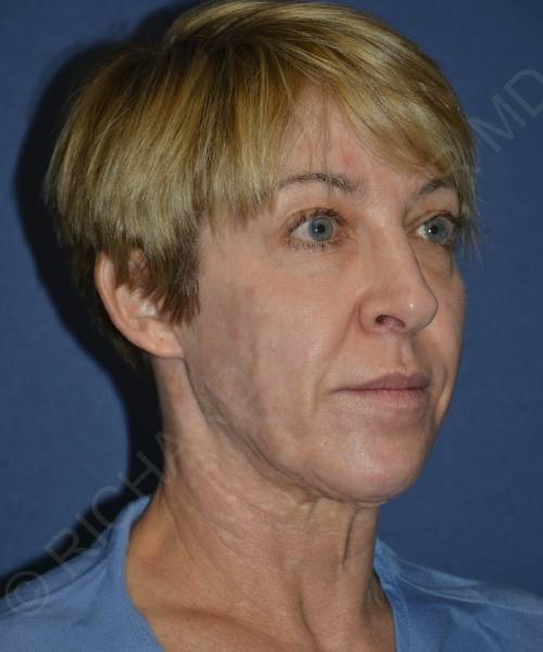 before facelift | neck lift female patient right angle view case 4856