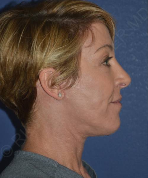 after facelift | neck lift female patient right side view case 4856