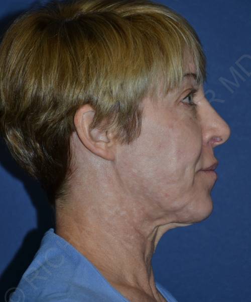 before facelift | neck lift female patient right side view case 4856