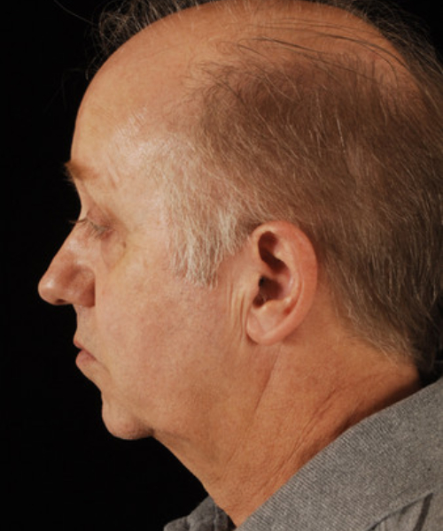 before facelift | neck lift male patient left side view case 5549