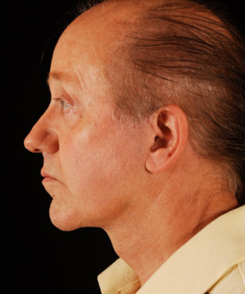 after facelift | neck lift male patient left side view case 5549