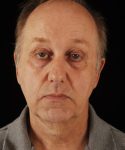 before facelift | neck lift male patient front view case 5549