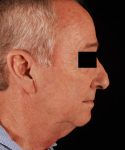 before facelift | neck lift male patient right side view case 5559