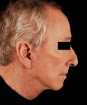 after facelift | neck lift male patient right side view case 5559