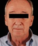 before facelift | neck lift male patient front view case 5559