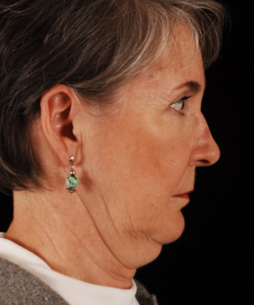before face and neck lift side view female patient case 5564