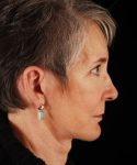 after face and neck lift side view female patient case 5564