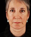 after face and neck lift front view female patient case 5564