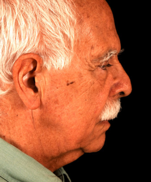 before face and neck lift side view male patient case 5568