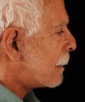 after face and neck lift side view male patient case 5568