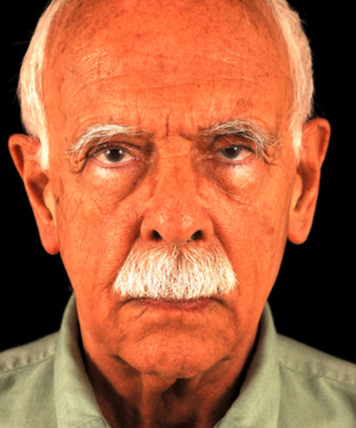 before face and neck lift front view male patient case 5568