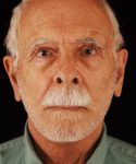 after face and neck lift front view male patient case 5568