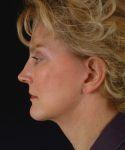after face and neck lift side view female patient case 5574