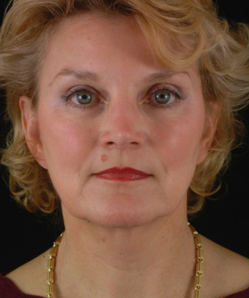 before face and neck lift front view female patient case 5574