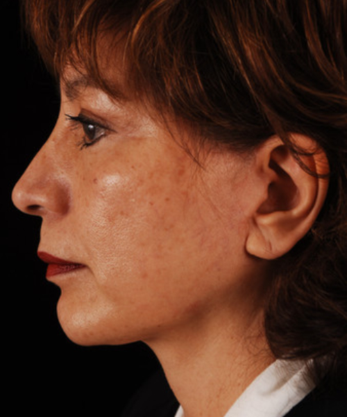 after face and neck lift side view female patient case 5584