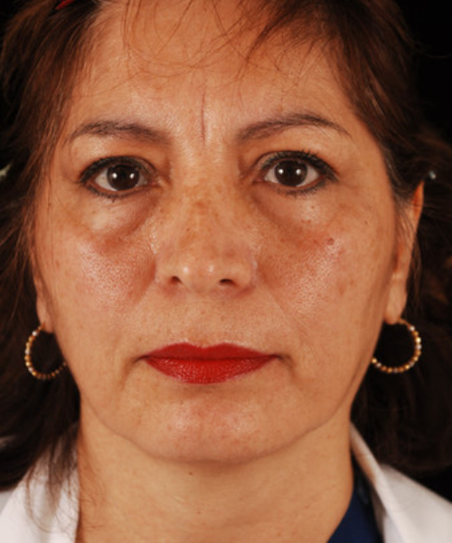 before face and neck lift front view female patient case 5584
