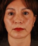 after face and neck lift front view female patient case 5584