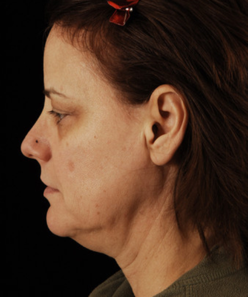 before face and neck lift side view female patient case 5689