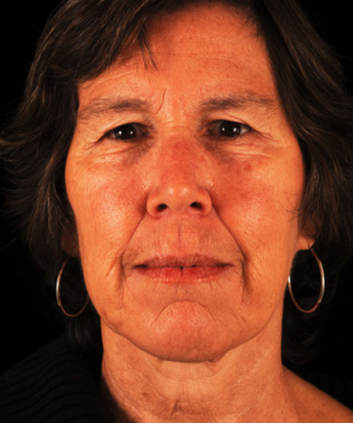 before face and neck lift front view female patient case 5594