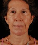 after face and neck lift front view female patient case 5594