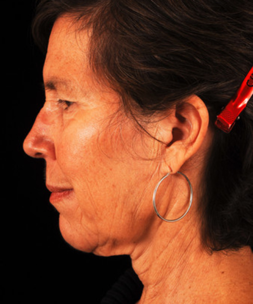 before face and neck lift side view female patient case 5594