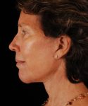 after face and neck lift side view female patient case 5594