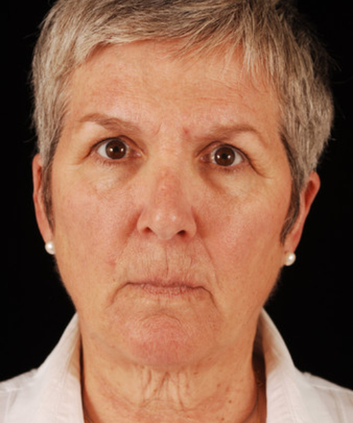 before face and neck lift front view female patient case 5651