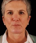 after face and neck lift front view female patient case 5651