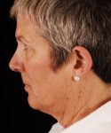 before face and neck lift side view female patient case 5651