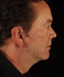 after face and neck lift side view male patient case 5656