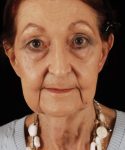 before face and neck lift front view female patient case 5661