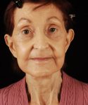 after face and neck lift front view female patient case 5661