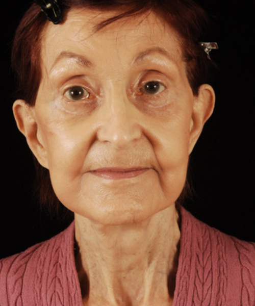 after face and neck lift front view female patient case 5661